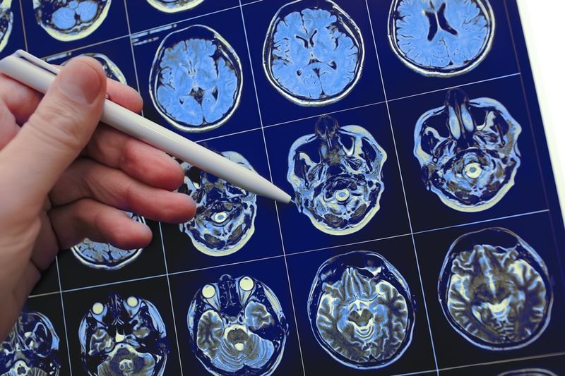 طبيب يشير بقلمه إلى جزء الدماغ في نتيجة دراسة التصوير بالرنين المغناطيسي'
