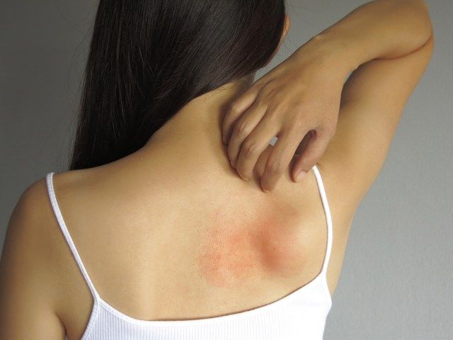 امرأة تخدش ظهرها المصاب بحكة بطفح جلدي'