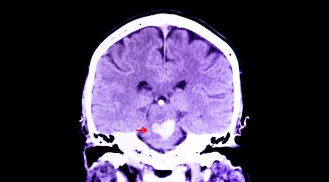 التصوير المقطعي المحوسب لدماغ مريض يعاني من نزيف داخل الجمجمة'