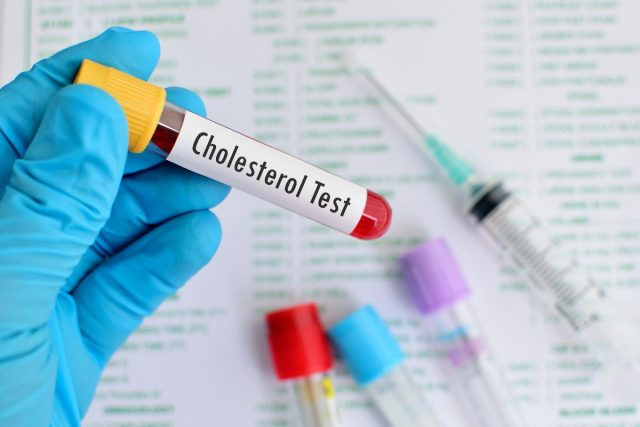   طبيب المقربة's hand holding blood sample for cholesterol